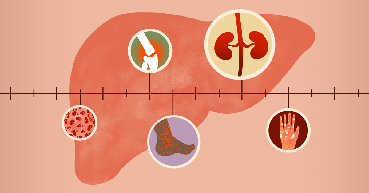 Extrahepatic Conditions Related to Hepatitis C