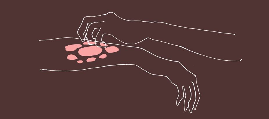 animated doodle of hands scratching at hives on arm
