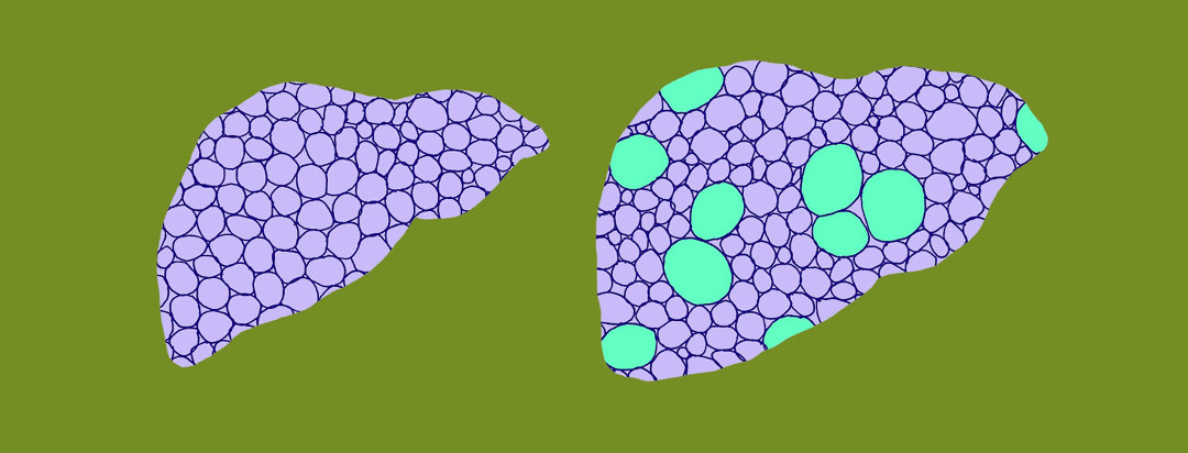 two livers, each showing their cellular makeup, with one liver filled with fatty cells