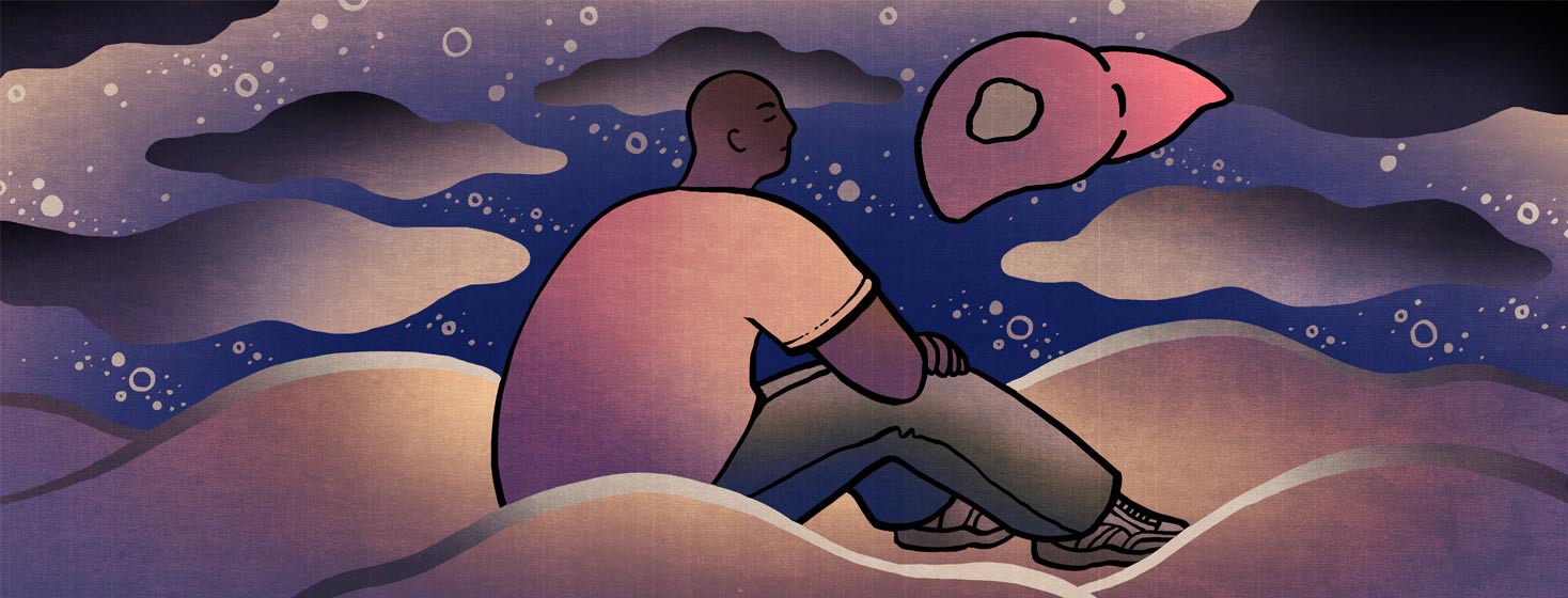 a man sits on clouds in the sky as he stares at a liver with hepatocellular carcinoma and ponders